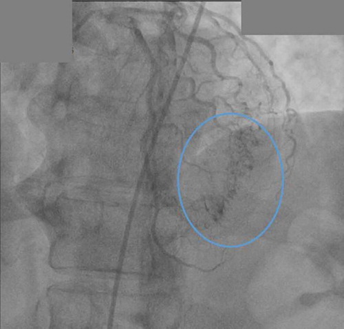 Figure 1. Coronary angiography showing multiple coronary artery microfistulae arising from distal end of left anterior descending artery (LAD) emptying into the left ventricle (blue circle).