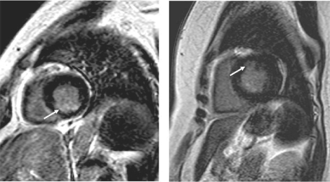 Figure 1 Short-axis view of LV from the two diabetic women with MRI-visible subendocardial infarction (arrow). In the patient with multi-vessel disease (left panel) the location of subendocardial MI is inferior while the patient with normal coronary angiogram (right panel) had smaller subendocardial MI located in the anterior LV wall.