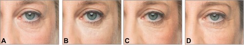 Figure 3 A 57-year-old female patient with a Merz Aesthetics Scale® score of 2 for infraorbital hollow at baseline (A) received supraperiosteal injections of 0.7 mL CPM® hyaluronic acid gel per side. (B) 3 months, (C) 6 months, and (D) 9 months after treatment.® Dr. Huber-Vorländer.