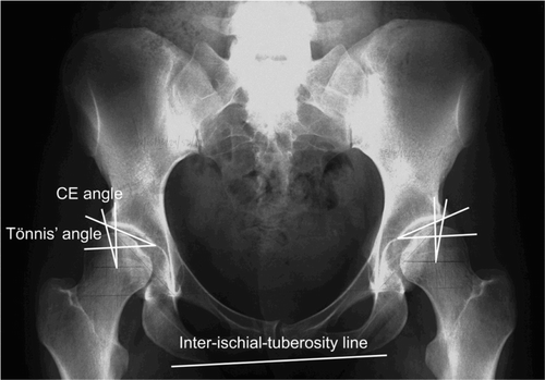 Figure 3. The CE angle and Tönnis' angle are measured on an AP radiograph in order to diagnose hip dysplasia. Joint space width is measured and degenerative changes described.