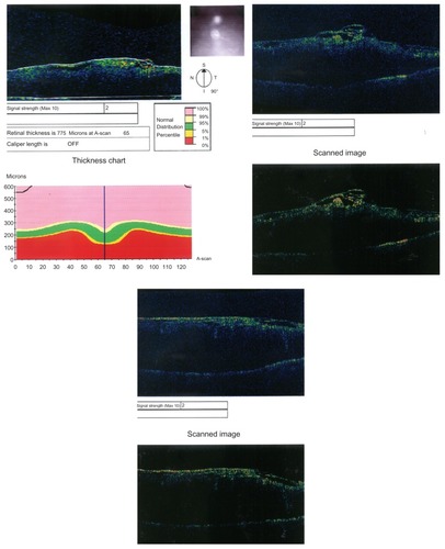 Figure 6 Eye 7 in the series with residual epiretinal membrane, inducing macular detachment.