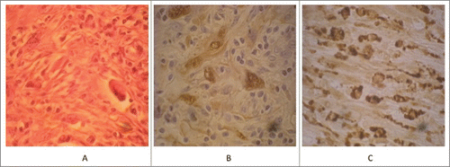 Figure 2. Haematoxylin-eosin staining on surgical samples (A), immunohistochemistry results for S-100 (B) and CD68 (C).
