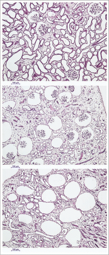 Figure 4 The spectrum of renal cortical responses to vitrification and rewarming. Top: area showing predominant survival of both tubules and glomeruli. Scale bars all represent 100 microns. Middle: transitional zone between predominantly surviving superficial renal cortex and non-surviving cortex, showing loss of tubules but survival of glomeruli. Bottom: non-surviving superficial cortex, showing loss of both tubules and glomeruli, with ballooning of Bowman's capsule. PAS stain.
