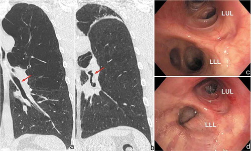 Figure 2. Bronchial angulation of the non-treated lobe left lower lobe. The red arrows indicate the airways before (a and c) and after (b and d) treatment, and shows the folding of the airway of the left lower lobe. Abbreviations: LUL; Left Upper Lobe, LLL; Left Lower Lobe