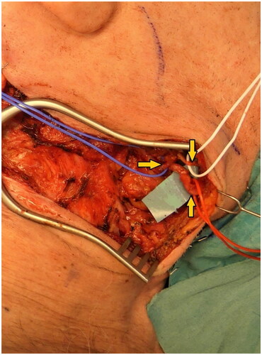 Figure 4. Defect coverage using a free myocutaneous latissimus dorsi flap with anastomosis to the right facial artery (intraoperatively). marked with arrows: facial artery and vein (red and blue rubber loops) and marginal mandibular branch of the facial nerve (white rubber loop).