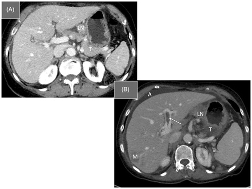 Figure 5. Pt # 2: Female 81 years of age. (A) Axial MDCT at the time of diagnosis showing the gastric tumour (T) located in the antrum, with lymph nodes (LN) at the lesser curvature. (B) Five months after primary diagnosis: disease progression with liver metastasis (M), tumour and lymph node growth (T) along the lesser curvature, ascites (A) and thrombus in portal veins (white arrow).