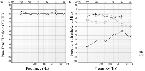 Figure 3. Audiogram at 3 months after surgery. Unaffected side (a). Hearing improvement in the affected side (b). black lines: prior to surgery. Grey lines: after surgery.