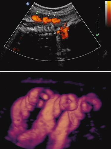 Figure 5 Sagittal image of the same fetus depicted in Figure 4 now vertex-presenting at 40 weeks’ gestation, with decelerated fetal growth (and now overt fetal growth restriction). Upper panel: Power Doppler image of triple nuchal cord. Lower panel: Power Doppler three-dimensional image of above. Note the presence of coiled nuchal cords. Reproduced with permission from Sherer DM, Dalloul M, Sabir S, London V, Haughton M, Abulafia O. Persistent quadruple nuchal cord throughout the third trimester associated with decelerating fetal growth. Ultrasound Obstet Gynecol. 2017;49(3):409–410. Copyright © 2016 ISUOG. Published by John Wiley & Sons Ltd.Citation87