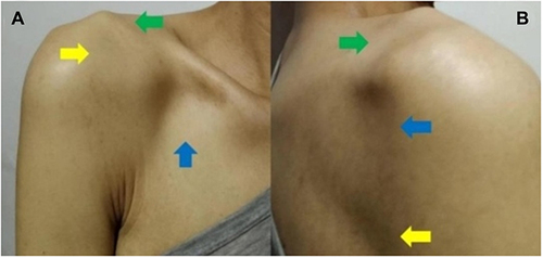 Figure 1 Clinical presentation. The patient was asked to lift and abduct the proximal end of the right upper limb, and it was observed that the patient had failed to lift and abduct the proximal end of the right upper limb (A). Visual examination showed a square shoulder deformity (A, green arrow) and mild atrophy of the right pectoralis major (A, blue arrow), right deltoid (A, yellow arrow), right supraspinatus (B, green arrow), right infraspinatus, right teres minor (B, blue arrow), and right latissimus dorsi (B, yellow arrow).