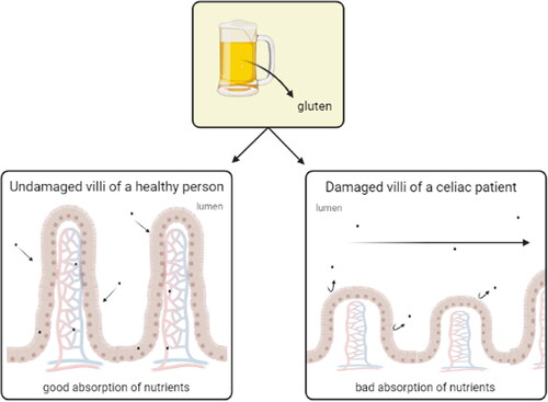 Figure 3. Gluten assimilation. Healthy people with undamaged villi have a good absorption of nutrients while celiac patient with damaged villi have a bad absorption of nutrients.