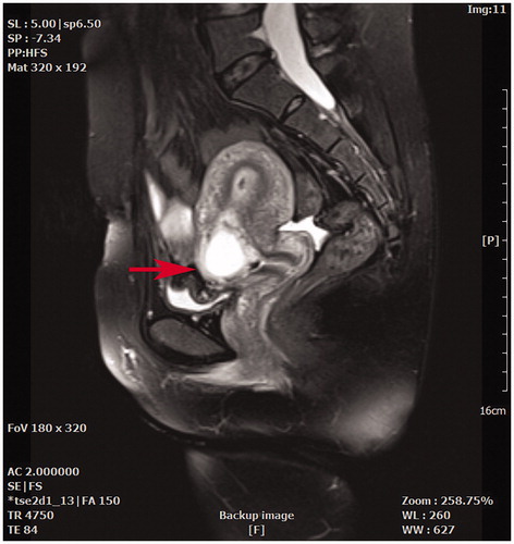 Figure 1. A sagittal view magnetic resonance imaging showed a gestational sac embedding at a previous cesarean section scar (red arrow).