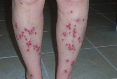 Figure 1 Morgellons patient’s lower legs. Similar lesions covered her trunk and arms. There were no excoriations or secondary infections. Photo courtesy of Cindy Casey, Charles E Holman Foundation, Austin, Texas. Reproduced with permission.