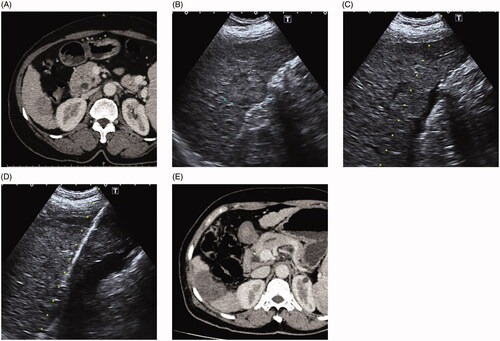 Figure 1. (A) 65-year-old female with hepatocellular carcinoma. A CT prior to ablation demonstrates a hypoenhancing lesion during venous phase in segment 6. The tumor is close to the colon, thus thermal injury to the adjacent colon after thermal ablation is expected. (B) Ultrasound image shows the lesion is located close to the adjacent colon wall and partly protrudes from the liver capsule. (C) After introducing artificial ascites, a small amount of loculated fluid collection is made in the perihepatic space near the index tumor. (D) Microwave antenna was inserted into the target tumor under ultrasound guided. (E) One-month post-ablation CT demonstrates the ablation zone with complete response and no damage to surrounding colon.