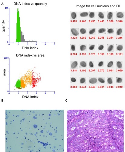 Figure 2 DNA quantitative analysis and cytological histopathological diagnosis of endometrial carcinoma. (A) Quantitative analysis of DNA images of endometrial carcinoma. DI, DNA index for short, which means the ratio of the DNA-IOD value of the tested cells to that of the normal cells. Cytological images (System scan cell under magnification, ×20.) (B) and histopathological images (magnification, ×200.) (C) of endometrial carcinoma.