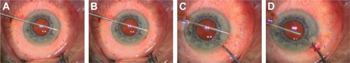 Figure 3 Sequence of XEN45 gel stent implant (A–D).