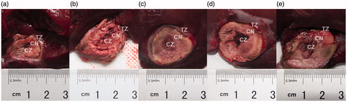 Figure 2. Macroscopic features of the ablation zones in vivo rabbit livers, 14 days after radiofrequency ablation (RFA) at 103 °C and 30 W for 3 min, by perfusion group. (a) Normal saline control, (b) 5% HCl, (c) 10% HCl, (d) 15% HCl, and (e) 20% HCl. Based on gross and microscopic morphology, three ablation sub-zones were identified from the line of electrode insertion outward as the black and moist sediment central zone (CZ), the grey coagulation necrosis zone (CN), and the well-demarcated transition zone (TZ).