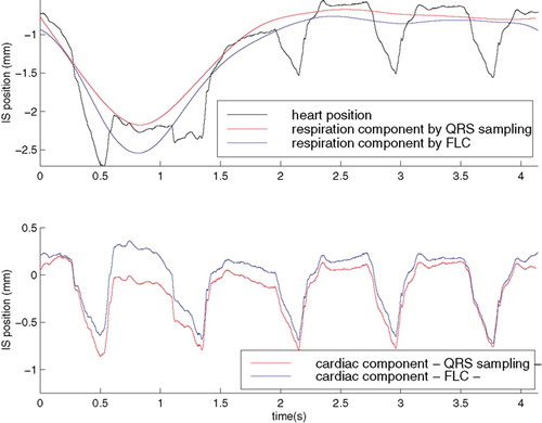 Figure 11. Extracted respiratory motion with QRS sampling and FLC. [Color version available online.]