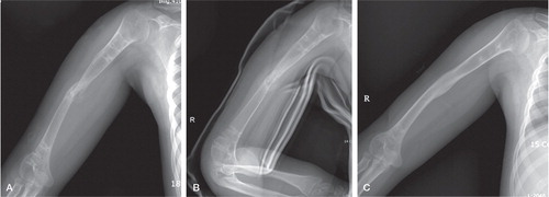 Figure 3. A. Case no 5. Refracture after removal of the fixator at the mid-diaphyseal level.B. Close reduction and U-arm slab application with abduction splint for 6 weeks.C. Union of the fracture site X months after the fracture.