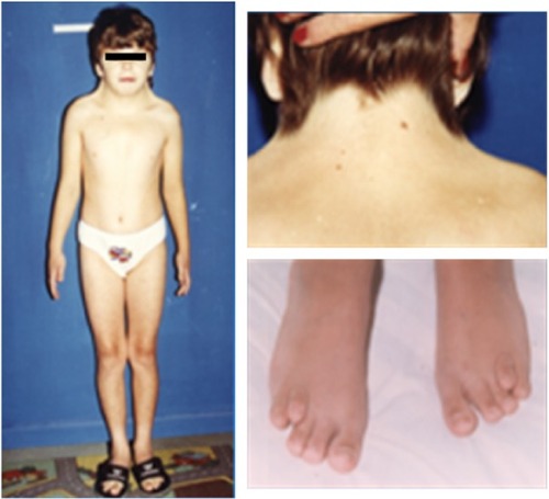 Figure 6 Classical phenotype of a patient (10 years old) with Turner syndrome.