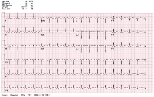 Figure 2. Electrocardiogram 30 min after initiation lipid emulsion bolus, demonstrating narrowing of QRS complex, narrowing of the QTc interval, and improvement of heart rate.