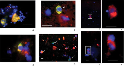 Figure 1. Examples of fields of cells recovered from 60% fractions following density gradient centrifugation. Samples from N (A), S (B, C and D) and P patients (E, F) were processed. Fields (merged channels) from samples are shown labeled (red channel) for PSMA (A, B, E, F), NKX3.1 (C) and CD24 (D). All except the P samples (E, F) were co-labeled (green channel) for KRT18 and DAPI (blue channel) was included throughout. Panel A shows two PSMA+/KRT18+ features each with two nuclei indicating either individual, closely juxtaposed cells or possibly two bi-nucleate cells surrounded by numerous, much smaller sperm nuclei. Panel B shows a similarly PSMA+/KRT18+ sized cell, with triangular-shaped nucleus and no sign of sperm. Panel C shows an example of an NKX3.1+/KRT18+ cell and panel D shows a low powered field with CD24+/KRT18+ cells (short barbed arrowheads) and CD24−/KRT18+ cells (long barbed arrowheads). The latter may be neutrophils. The panel also shows an example of a CD24+/KRT18−/DAPI− ‘entity’ that may be a cytoplasmic fragment (broken arrow). The remaining panels show examples of PSMA+ cells from P samples with (E/E’) and without (F/F’) signs of sperm. Note the presence of bright PSMA+ vacuoles in the cytoplasm of these cells, more clearly visible in the higher-powered images shown in E’ and F’. Green signals in fields obtained from co-labeled cells were sometimes overwhelmed by the red signals but as can be seen in Supplementary Figure 1 (single channels), were usually present. DAPI-only signals indicated by asterisks may represent cellular fragments remaining after necrosis or apoptosis. The scale bars throughout are 20 µm