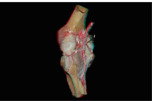 Figure 5 Posterior view of the knee: popliteal artery (1) and ramifications: medial superior genicular artery (2), medial inferior genicular artery (3), lateral superior genicular artery (4), middle genicular artery (5), and lateral inferior genicular artery (6).