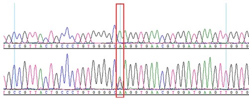 Figure 1(B). DNA sequencing analysis showing the nonsense mutation [β17(A14) Lys > Stop, HBB: c .52A > T].