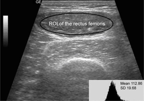 Figure 2 The histogram of the echo intensity (EI) of the rectus femoris.