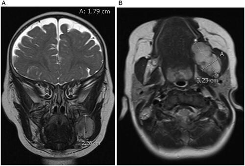 Figure 1. (A and B) MRI in the coronal and axial view seen in T2 demonstrating a 3.2 cm anterior-posterior (AP) × 2.3 cm craniocaudad (CC) × 1.8 cm transverse (T) mass arising from the left mandibular ramus with well-defined borders and with involvement of the angle and body of the mandible without involvement of the condylar or coronoid processes.