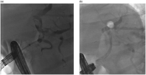 Figure 2. The fluoroscopy views of patient (number 1) with hepaticojejunostomy anastomotic stricture (a) before and (b) after stenting with Archimedes stents.