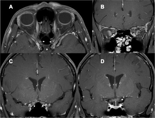 Figure 2 A 49-year-old HIV-infected female, who received antiretroviral therapy with well-controlled HIV viral load, presented with bilateral optic neuritis (immune reconstitution inflammatory syndrome-associated optic neuritis). (A) axial contrast-enhanced T1-weighted images with fat suppression showed enhancement of both optic nerves at the intracanal and intracranial segments (arrows); (B) coronal contrast-enhanced T1-weighted images with fat suppression showed enhancement of both optic nerves at the intraorbital segments (arrows); (C) coronal contrast-enhanced T1-weighted images with fat suppression showed enhancement of both optic nerves at the intracranial segments (arrows); (D) coronal contrast-enhanced T1-weighted images with fat suppression showed enhancement of the chiasm (arrow).