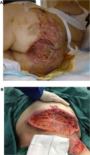 Figure 1 (A) Sacral pyoderma gangrenosum after multiple debridements. (B) Huge abdominal and left thigh wound defect with typical violaceous borders post-debridement.