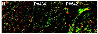 Figure 7. Evaluation of ΔΨm, using JC-1 dye, in myotubes from Pompe patients. Human primary myoblasts were derived from a healthy individual (control; N) and 2 Pompe patients with the adult form of the disease (P#484 & P#542). Cultured myotubes (7 d in differentiation media) were loaded with the dye and analyzed by confocal microscopy. The dye became red upon entry into healthy mitochondria (control). Abnormal ΔΨm in the diseased cells manifests as a marked decrease in red fluorescence (middle and right panels) compared to control. Bar = 20 μm.