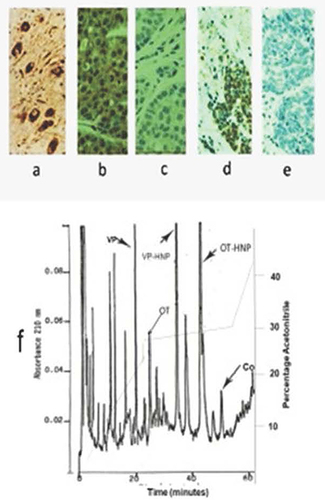 Figure 1 (a–f) Specificity of copeptin antiserum. Immunohistochemical staining (x 500) by Boris Y3 antiserum of formalin-fixed tissues. (a) Vasopressin neurons of human hypothalamus, (b) triple-negative breast cancer, (d) small-cell lung cancer. Tumor tissues are counterstained with hematoxylin. Absence of antibody staining for an adjacent section of (c) breast cancer, and (e) small-cell lung cancer, when peptide antigen is added to diluted antiserum. (f) HPLC absorbance profile at 210 nm of acid extract of human pituitary showing elution peak location and separation of vasopressin (VP), oxytocin (OT), vasopressin-associated human neurophysin (VP-HNP), oxytocin-associated human neurophysins (OT-HNP), and copeptin (Co).