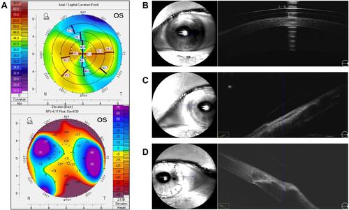 Figure 1 Corneal topography before wearing scleral lenses as measured with Pentacam (A) and OCT illustrating good central clearance (B), edge assessment of nasal (C) and temporal location (D) in case 1. The blue arrow corresponds to the directionality of the scan in relation to adjacent OCT cross section.