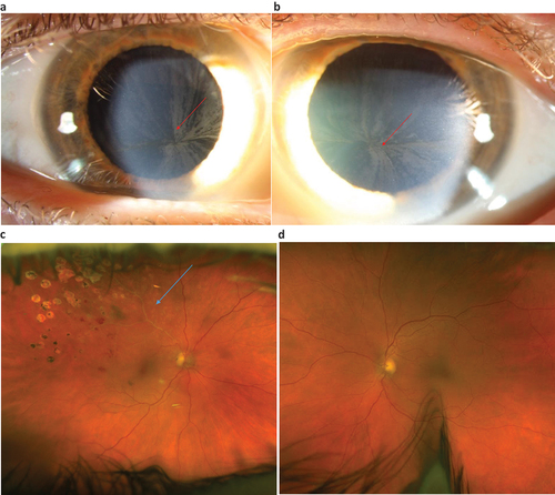 Figure 3. a–d. Photos showing cornea verticillate right and left eye (Figure 3a,b) and branch vein occlusion (BVO) in the right eye (Figure 3c) and anormal ocular fundus left eye (Figure 3d) in a woman with FD. She was diagnosed with FD at 60 years of age when an ophthalmologist detected cornea verticillate. Cataract surgery has been performed as well as laser treatment for the BVO (Figure 3c). Best corrected visual acuity was 0.7/1.0 right eye/left eye at latest follow up. (Photos published with permission from the patient).
