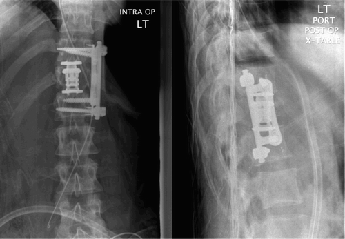 The patient was then taken to the operating room for a T12 corpectomy, with placement of an expandable cage (XPand, Globus Medical, Audubon, Pennsylvania) and fixation of T11 to L1 with a plate‐rod system (Gateway, Globus Medical, Audubon, Pennsylvania). Local autograft from the corpectomy was placed within the cage.