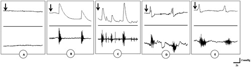 Figure 1. Polygraphic intraseminal pressure (upper) and EMG (lower) tracings showing the effects of saline solution (A), urethral stimulation (B), penile stimulation (C), aqueous extract (D) and methanol extract of G. tessmannii (20 mg/kg) (E) in spinal male rats. Arrows indicate the moment of substance application.