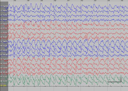 Figure S5 Absence status epilepticus in patient 8. Vertical bar- 100uV, horizontal bar - 1 sec.
