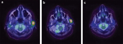 Figure 1. Positron Emission Tomography (PET) images revealing fluorodeoxyglucose (FDG) avid left submandibular lymphadenopathy at diagnosis (figure 1a) that showed no response following 3 cycles of SMILE chemotherapy (figure 1b), but resolved completely with 2 cycles of B-GIFOX (figure 1c).