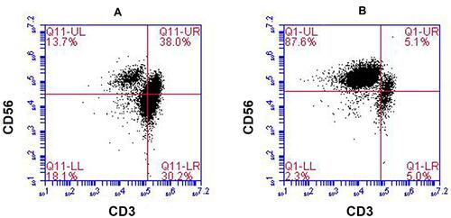 Figure 1 Representative results regarding the NK cell population from the patient’s peripheral blood before and after expansion. (A) The proportion of NK cells before expansion (13.7%). (B) The proportion of NK cells on day 18 of expansion (87.6%). NK cells (CD3−CD56+) were analyzed by flow cytometry with fluorescent antibody staining.