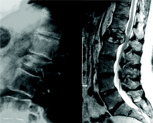 Figure 2. A neurologically intact patient (0 points) with an L1 burst fracture (2 points) and an intact posterior ligamentous complex (0 points). Thus, the total TLICS score is 2. The TLICS system treatment recommendation is therefore nonoperative treatment. This patient was treated in a thoracolumbosacral orthosis.