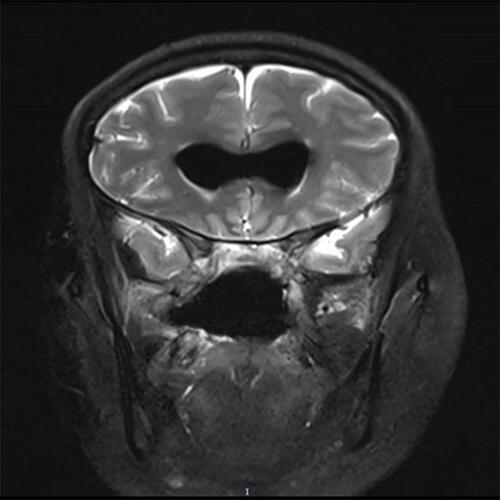 Figure 2 Magnetic resonance imaging revealing pneumocephalus in the bilateral ventricles, with slight enlargement of the anterior horn of the lateral ventricles.