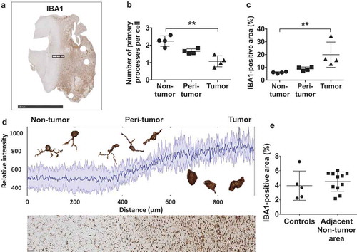 Figure 5. Tumor-associated macrophages (TAM) exhibit distinct morphologies in tumor and non-tumor regions. (a) Image of a GBM section with adjacent brain tissue stained with IBA1. The black rectangles represent images captured to quantify differences in the morphology of TAM in non-tumor (left), peri-tumor (mid), and tumor (right) areas, as well as changes in IBA1-positivity. Peri-tumor areas were defined as a field in which half of the area is non-tumor and the other half is tumor tissue based on macrophage morphology and cellular density. Scale bar corresponds to a length of 10 millimeters. (b) The number of primary processes per IBA1+ cell, a marker for macrophage shape and activation, changes incrementally from non-tumor to tumor areas. The data points represent average numbers of processes per cell in each area of different tumors. (c) Quantification shows the percentage area covered by IBA1+ TAM gradually increases from non-tumor to tumor areas, with each dot representing the average of one sample. Dunn´s multiple comparisons test was performed. (d) Plot profile demonstrating a gradual increase in relative IBA1 immunopositivity with increasing proximity to the tumor parenchyma. The solid dark blue line indicates mean intensity and the shades represent ± one standard deviation (n = 4 independent samples). Examples of TAM highlight their morphological plasticity. The section below the plot profile exemplifies the areas used for this analysis. Staining intensity increases from left (non-tumor) to right (tumor). The scale bar indicates a length of 100 micrometers. (e) Quantification of the percentage of the IBA1-positive area in control brains and non-tumor areas adjacent to GBM indicated no significant difference. Dots represent averages of each sample. Mann-Whitney U test was performed.