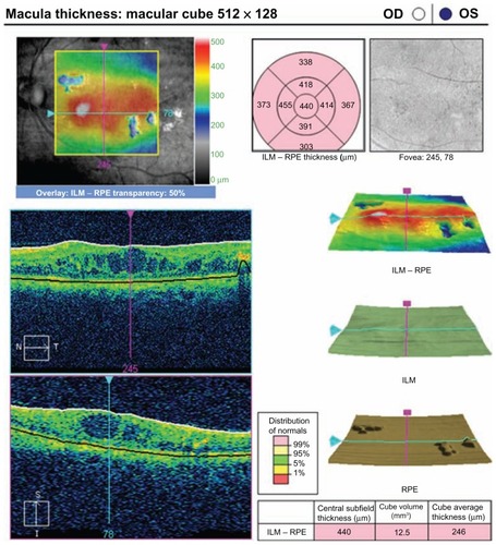 Figure 5 Optical coherence tomograph for a patient in group 1 at the preoperative visit.