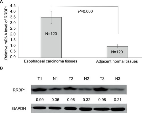Figure 1 RRBP1 expression.Notes: The expression of RRBP was detected in esophageal carcinoma and matched adjacent normal tissues by qRT-PCR (A) and Western blot (B). T, esophageal carcinoma tissue; N, matched adjacent normal esophageal tissue.