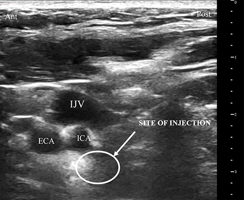 Figure 1 Ultrasound image of the neck demonstrating ICA, ECA and IJV at submandibular region.