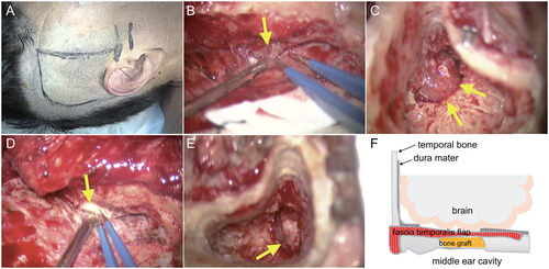 Figure 3. Intraoperative findings and schematic of operative procedures. (A) Schematic drawing of skin incision. (B,C) Bone defects and meningoencephaloceles were identified in the middle cranial fossa (arrow in B) and in the mastoid cavity of the right ear (arrows in C). (D) A free bone graft was placed in the bone defect of the middle cranial fossa. E. A meningoencephalocele was also identified in the mastoid cavity of the left ear. (F) Schematic drawing of reconstruction with an extradural flap of the temporalis fascia and free bone grafts for repair of the dura mater and bony wall of the middle cranial fossa.