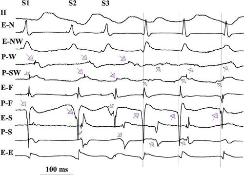 Figure 1.  Electrograms during a ventricular pacing protocol (last in the drive, S1 and two prematures, S2 S3) followed by 3 VT complexes (vertical lines indicate the onset of surface ECG of VT complexes). Shown are surface ECG tracing lead II, and electrograms from Purkinje (P) or overlying endocardial (E) recording sites at focus of origin (P-F) and from west (P-W), north (E-N), south (P-S), southwest (P-SW), and east (E-E) of the focus. During pacing Purkinje potentials are indicated by downward arrows; all Purkinje potentials show delay with S2 and S3 with the greatest delay seen in P-SW, which in being greater than the cycle length between S3 and VT1, could suggest reentry within the Purkinje network. This delay argues for Purkinje origin of the potentials since the expected refractory period of Purkinje system would be greater than overlying endocardium. A similar delay is recorded in P-S and both recordings also are delayed between VT1 and VT2 (upward arrows), also suggesting possible reentry within the Purkinje system. VT3 complex originates from a Purkinje focus (P-F, with no major delay from VT2). An alternative explanation is that all three VT complexes originate from a focus at P-F.
