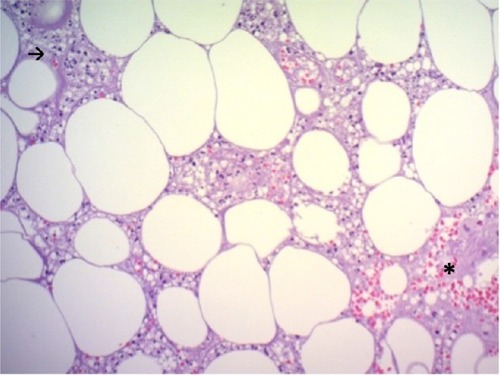 Figure 3 Hematoxylin and eosin stain, magnification 200×.
